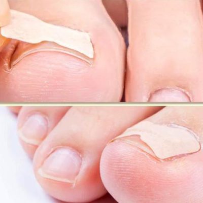 Ingrown Toenail Adjustment Patch