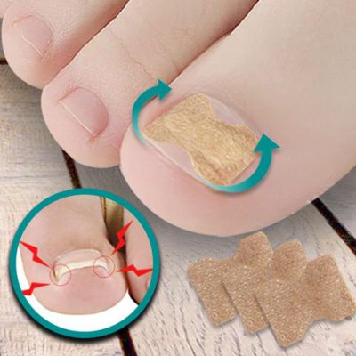 Ingrown Toenail Adjustment Patch