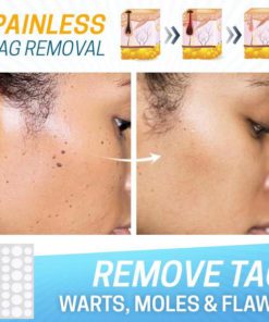 Skin Tag Pain-Free Remover Patch,Remover Patch,Skin Tag,Pain-Free