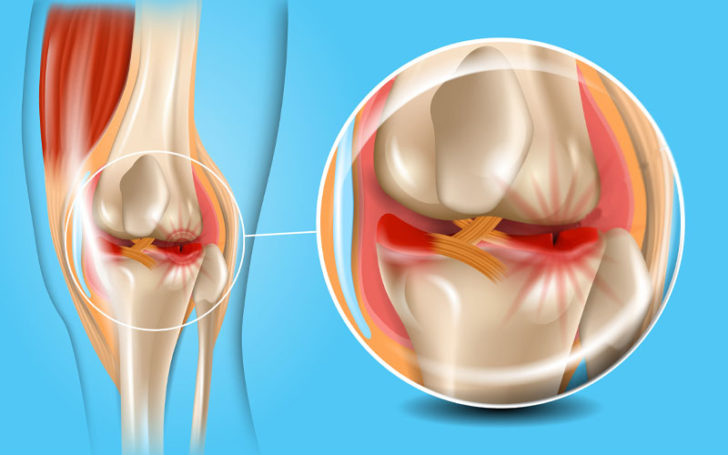 Behind Knee,Pain Behind Knee