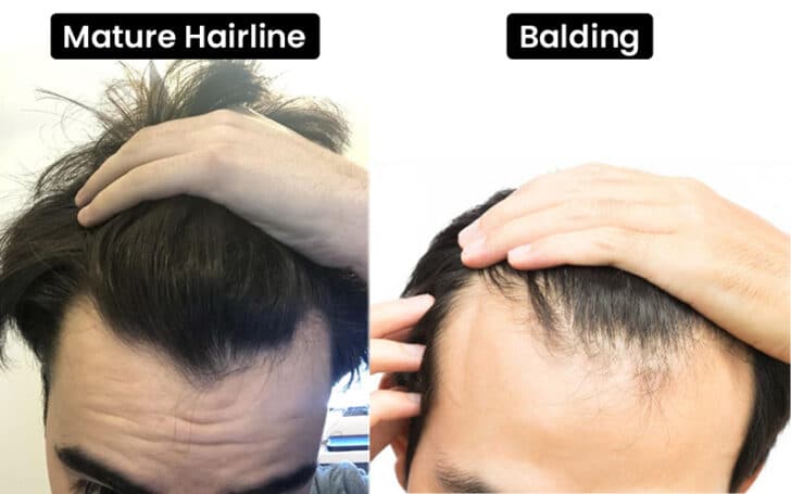 Mature Hairline