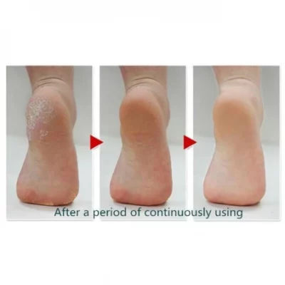 Perfect Pedi Callus Remover