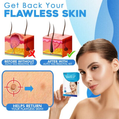 Auto Skin Tag Removal Kit