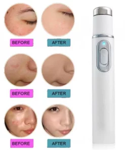 Anti-Fungal Anti-Acne Laser Pen