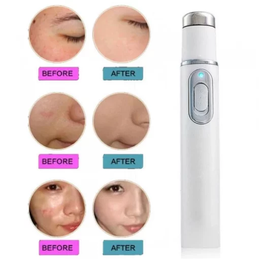 Anti-Fungal Anti-Acne Laser Pen